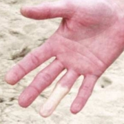 sindrome del dito bianco
